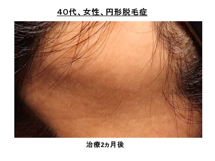 円形脱毛症　病院""